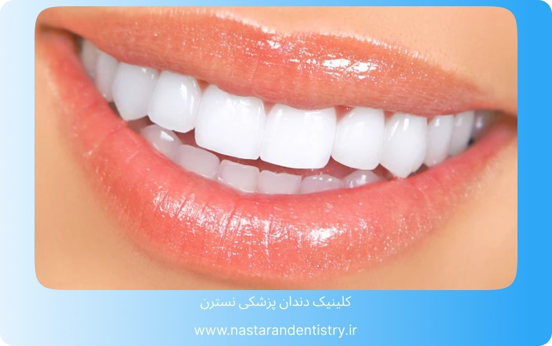 بهترین مرکز کامپوزیت دندان در تهران (4)