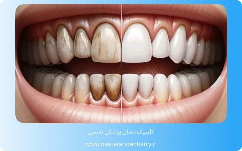 بهترین مرکز کامپوزیت دندان در تهران (5)