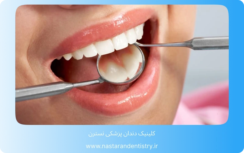 بهترین مرکز کامپوزیت دندان در تهران (7)