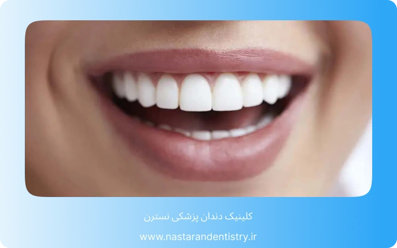 بهترین مرکز کامپوزیت دندان در تهران (8)