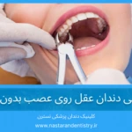 جراحی دندان عقل روی عصب بدون درد + مراقبتهای بعد از جراحی