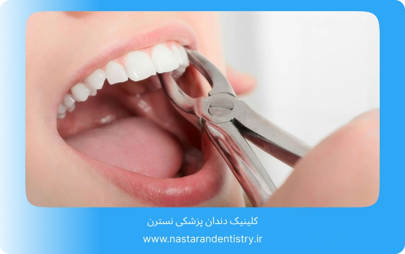 جراحی دندان عقل روی عصب بدون درد (3)