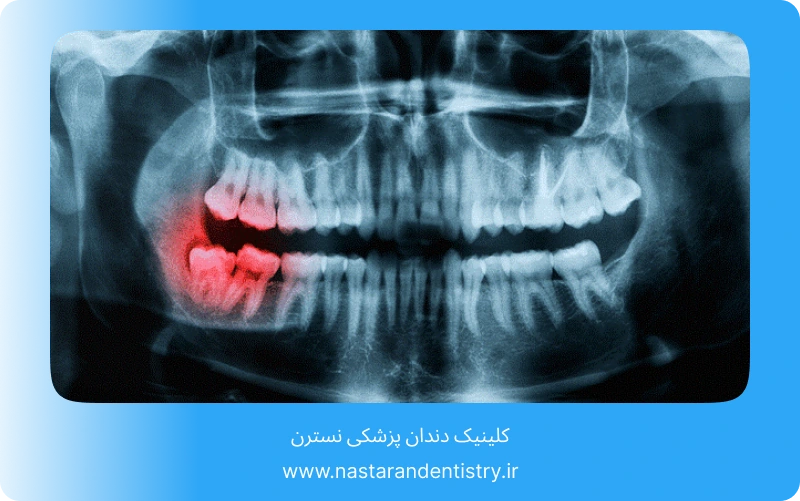 جراحی دندان عقل روی عصب بدون درد (5)