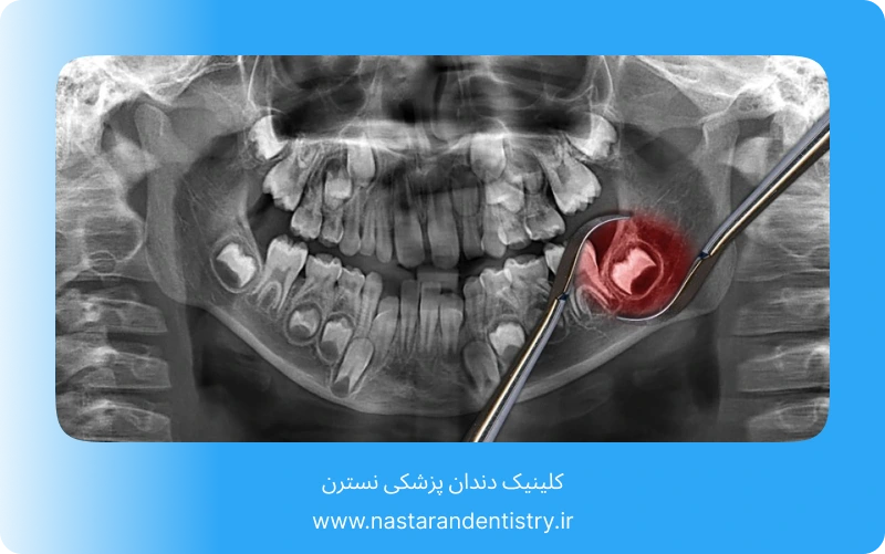 جراحی دندان عقل روی عصب بدون درد (6)