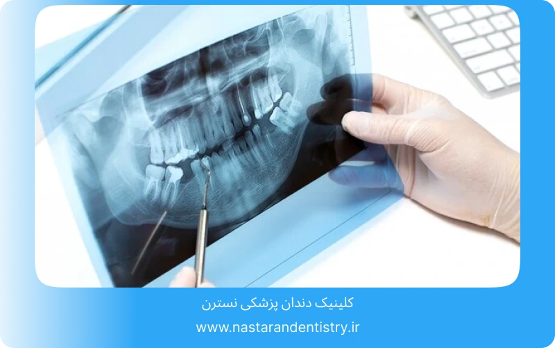 جراحی دندان عقل روی عصب بدون درد (7)