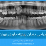 جراحی دندان نهفته جلو در تهران