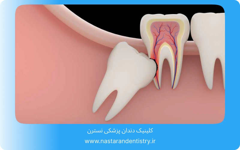 جراحی دندان نهفته جلو در تهران (4)