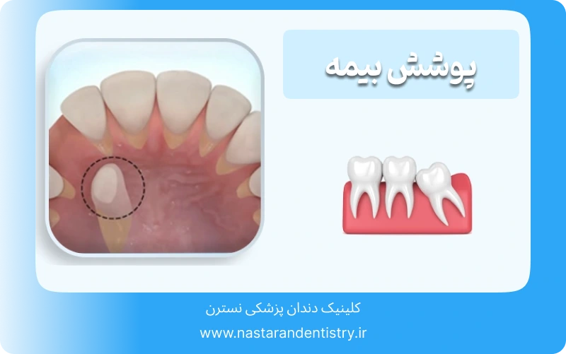 جراحی دندان نهفته در سقف دهان (6)