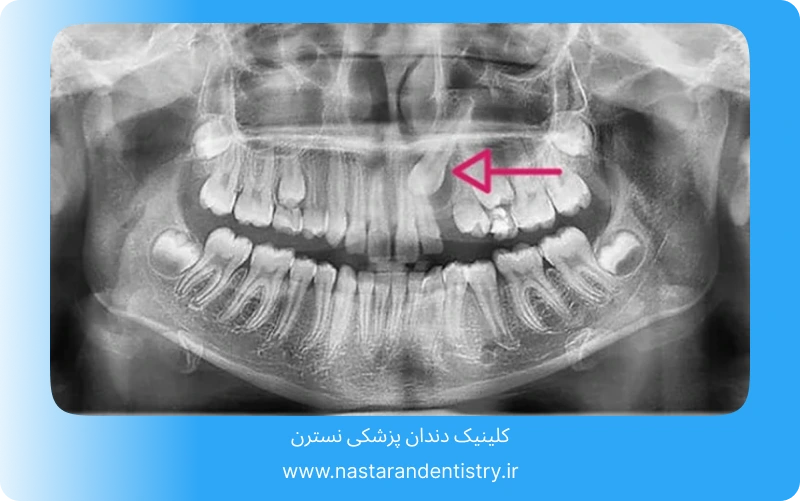 جراحی دندان نیش نهفته چقدر طول میکشد؟ (3)