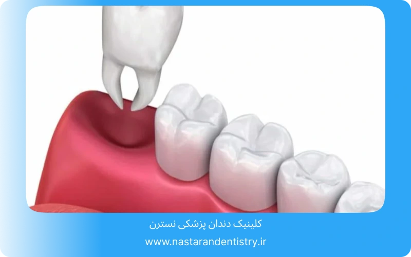 جراحی دندان نیش نهفته چقدر طول میکشد؟ (6)